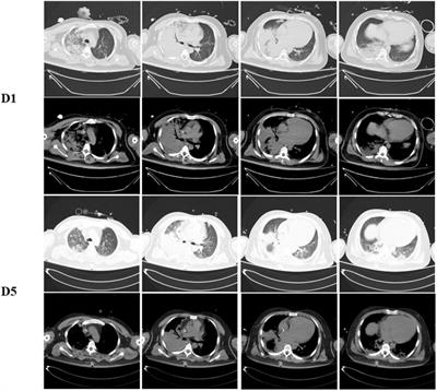 Case report: An unusual case of multisite embolism in a patient with adenovirus pneumoniae